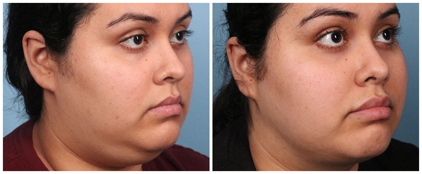 Liposuction Case #2 Right Oblique