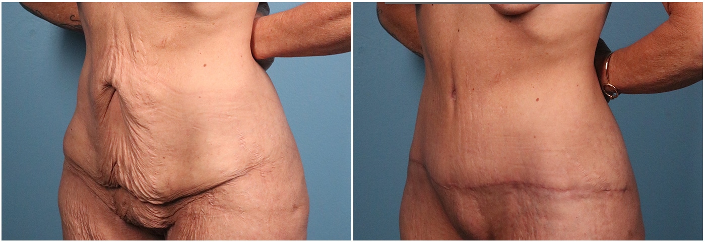 Tummy Tuck Case #2 Left Oblique