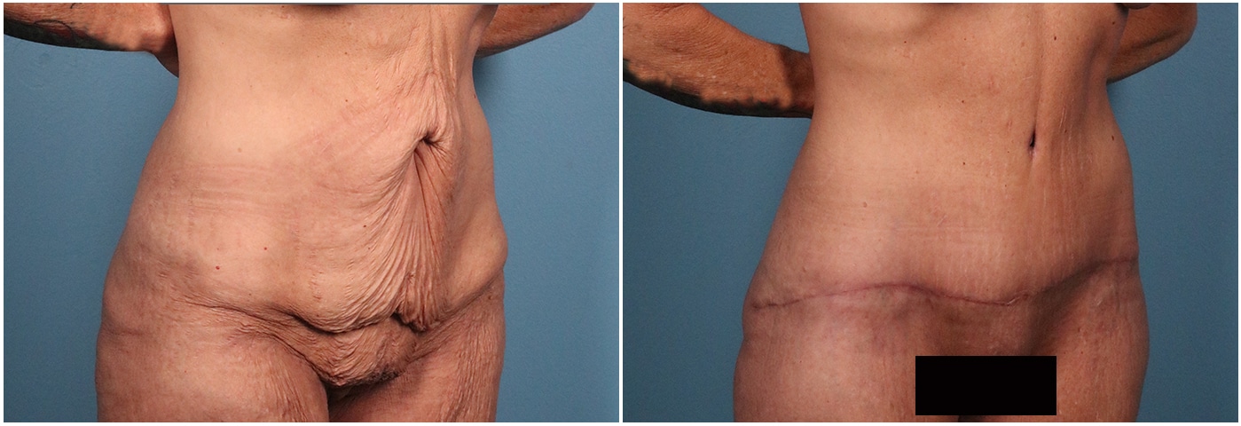 Tummy Tuck Case #2 Right Oblique