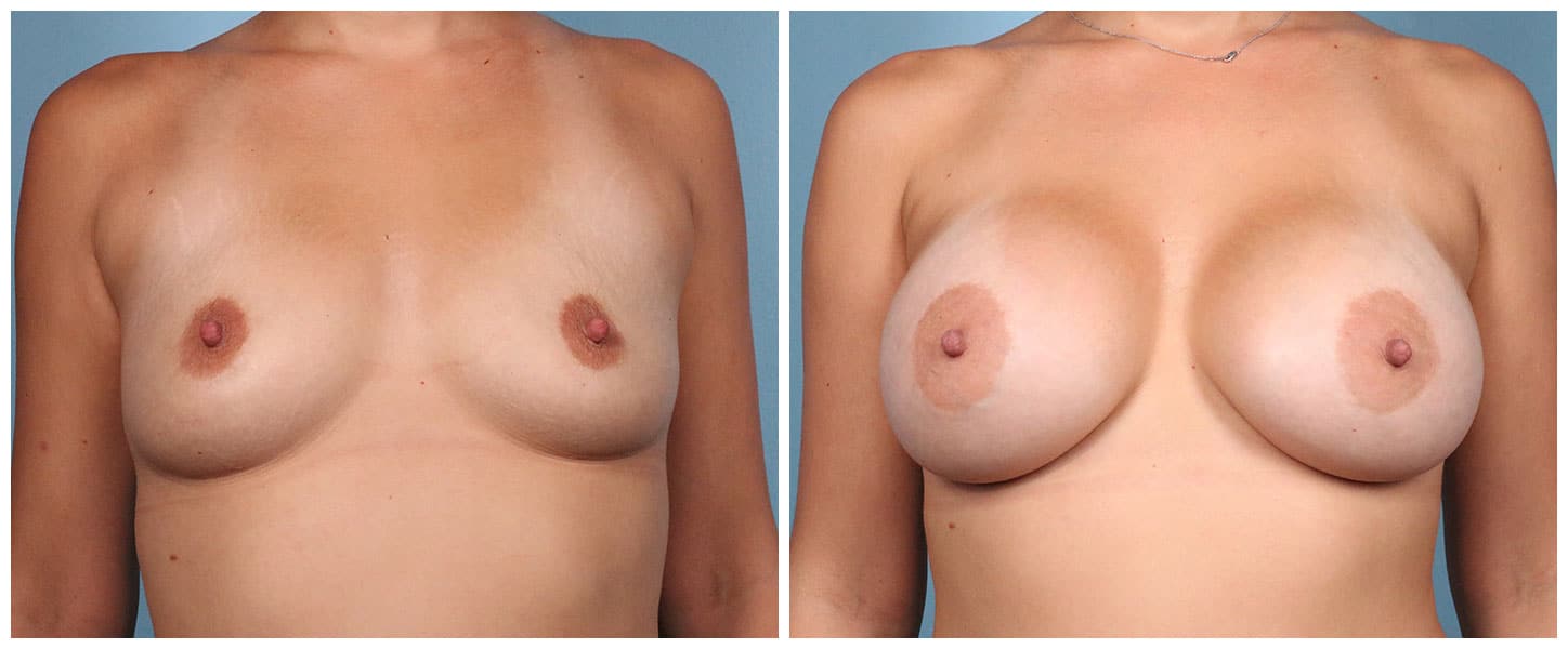 Breast Augmentation Case #10 Front