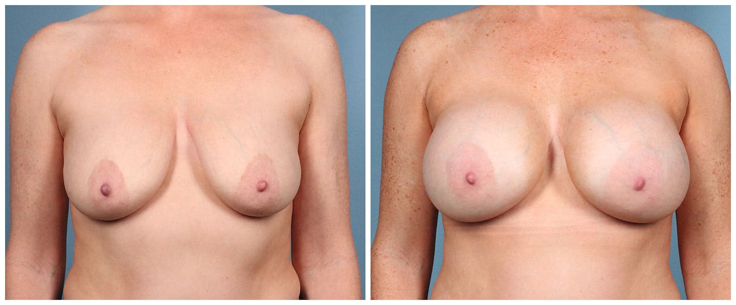 Breast Augmentation Case #9 Front