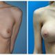 Breast Augmentation Case #8 Front