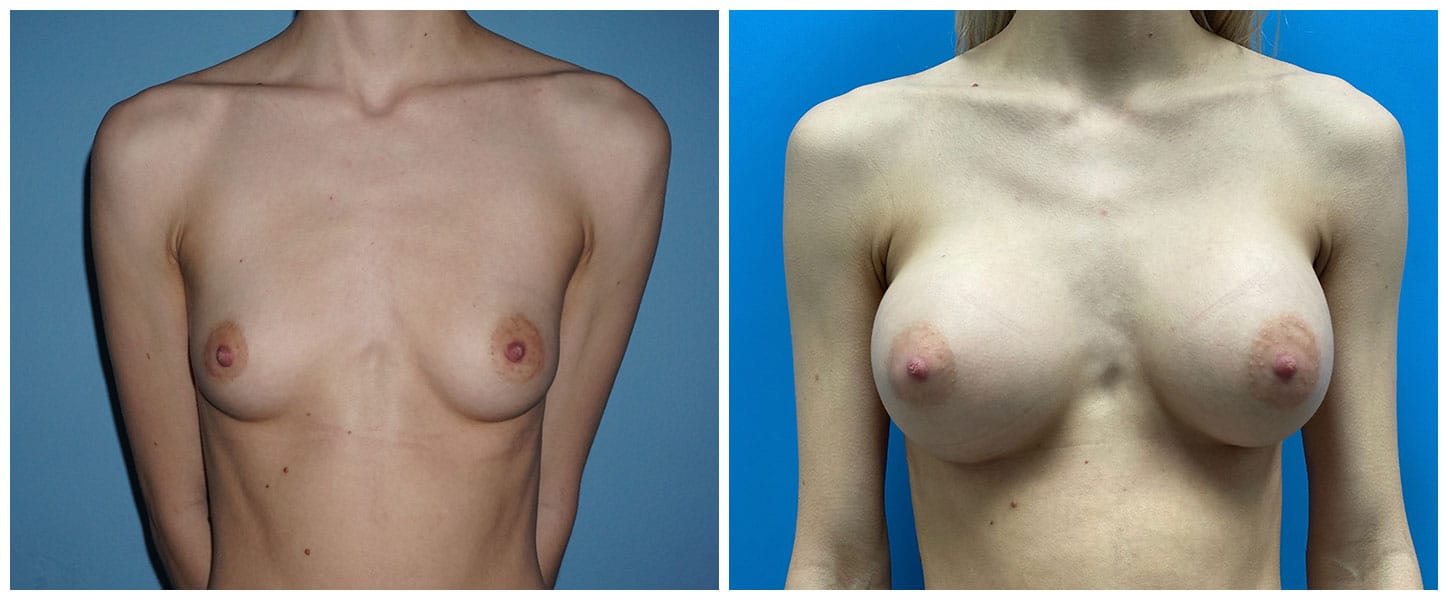 Breast Augmentation Case #8 Front