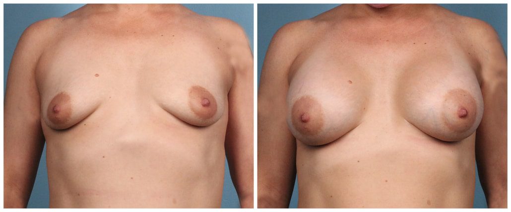 Breast Augmentation Case #7 Front