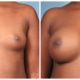 Breast Augmentation Case #6 Front