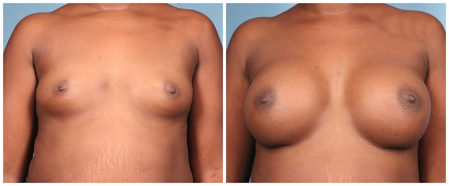 Breast Augmentation Case #6 Front