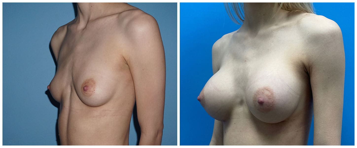 Breast Augmentation Case #8 Left Oblique