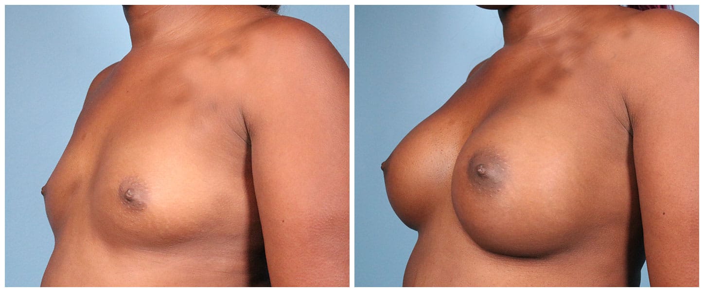 Breast Augmentation Case #6 Left Oblique