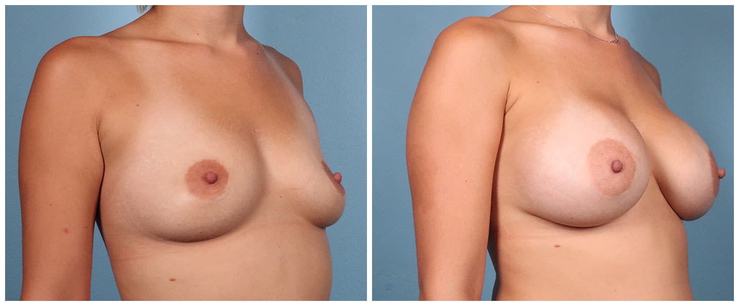 Breast Augmentation Case #10 Right Oblique