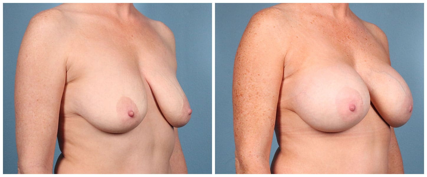 Breast Augmentation Case #9 Right Oblique