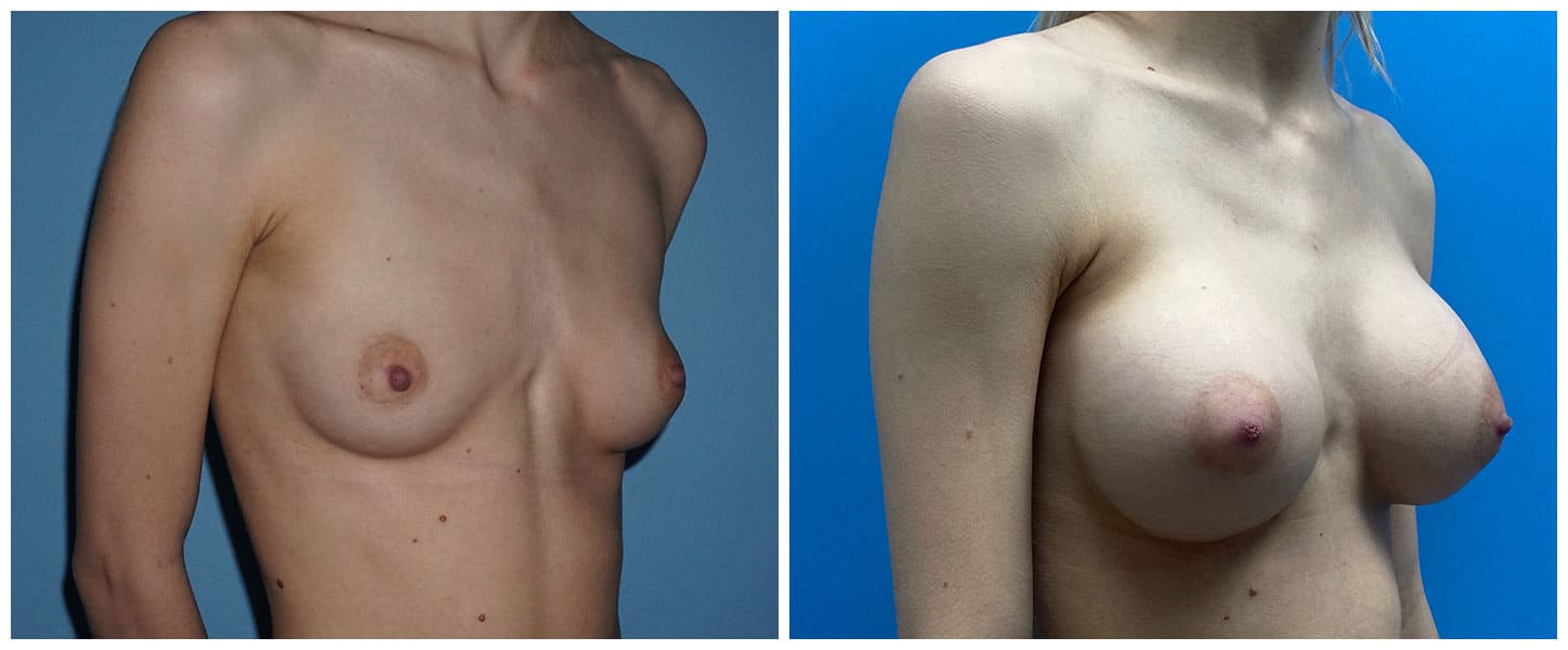 Breast Augmentation Case #8 Right Oblique