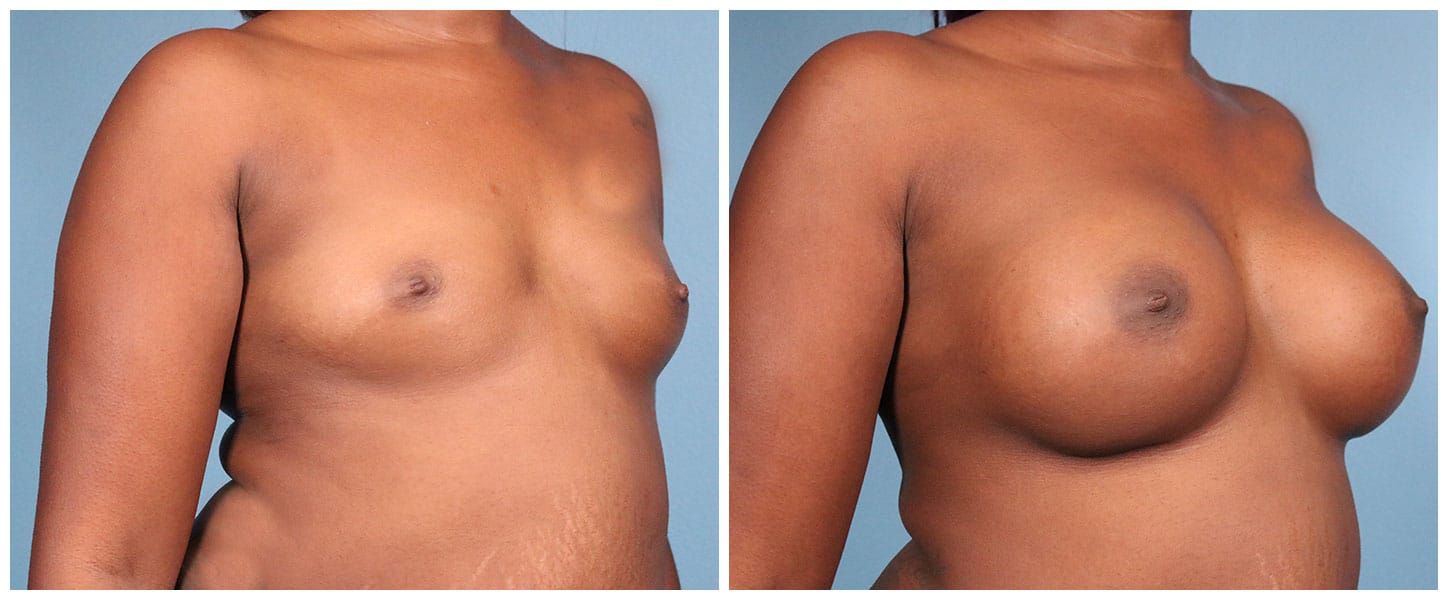 Breast Augmentation Case #6 Right Oblique