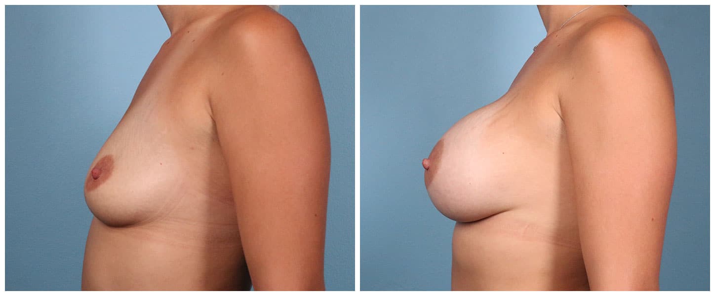 Breast Augmentation Case #10 Left