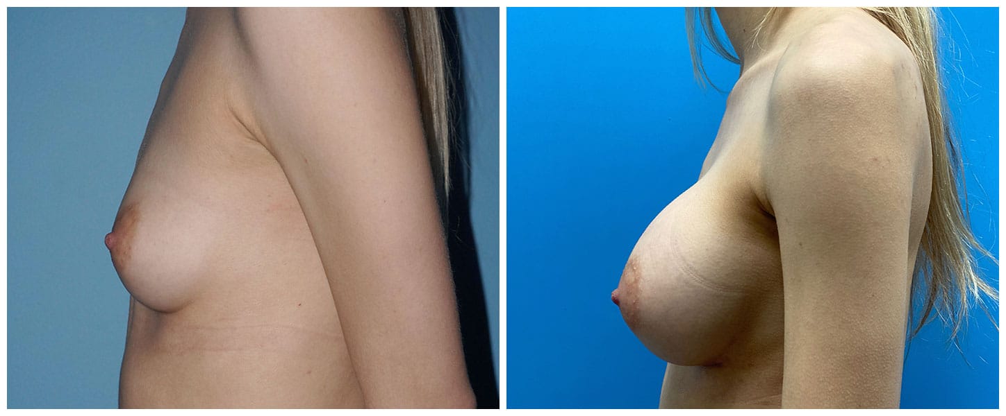 Breast Augmentation Case #8 Left