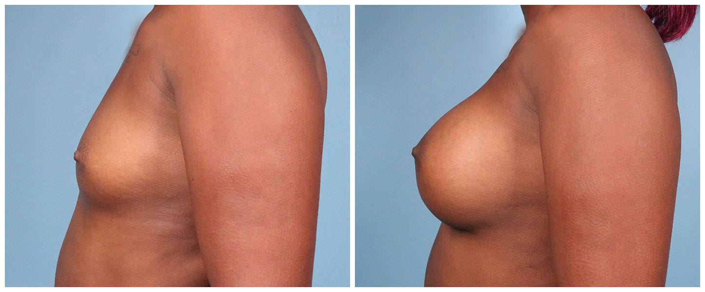 Breast Augmentation Case #6 Left