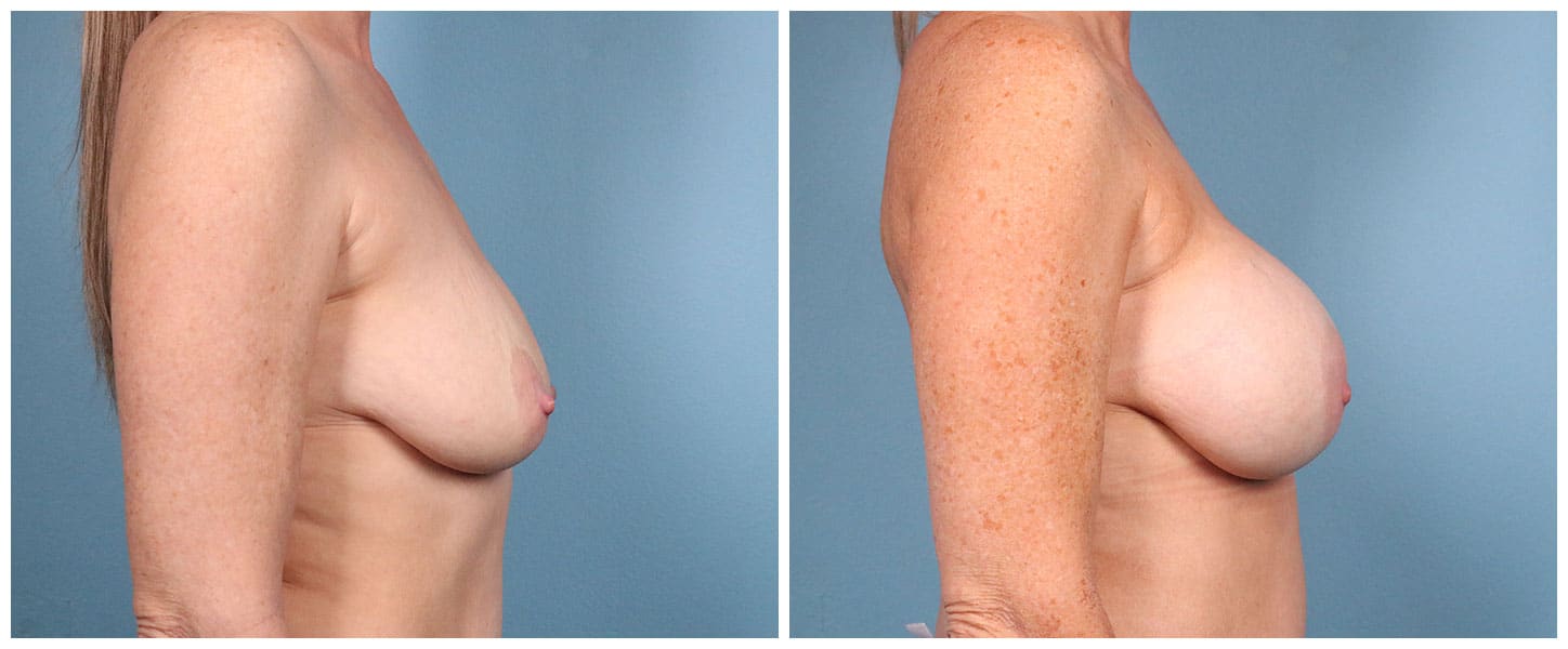 Breast Augmentation Case #9 Right
