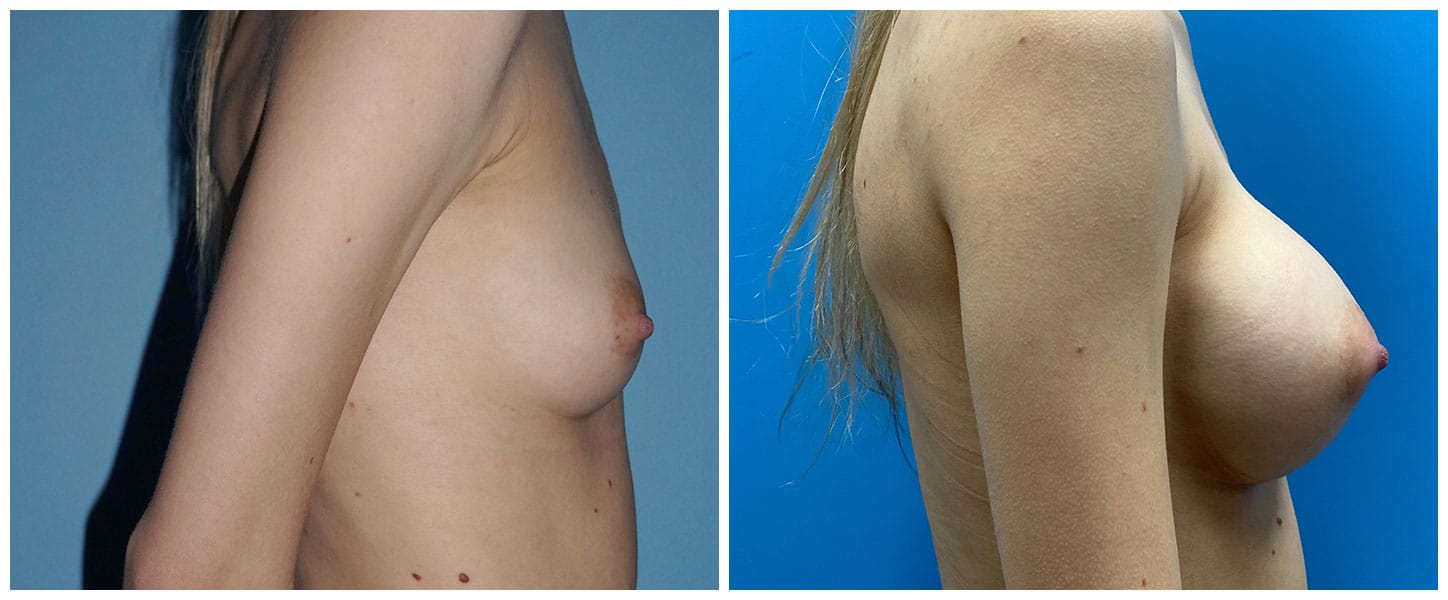Breast Augmentation Case #8 Right