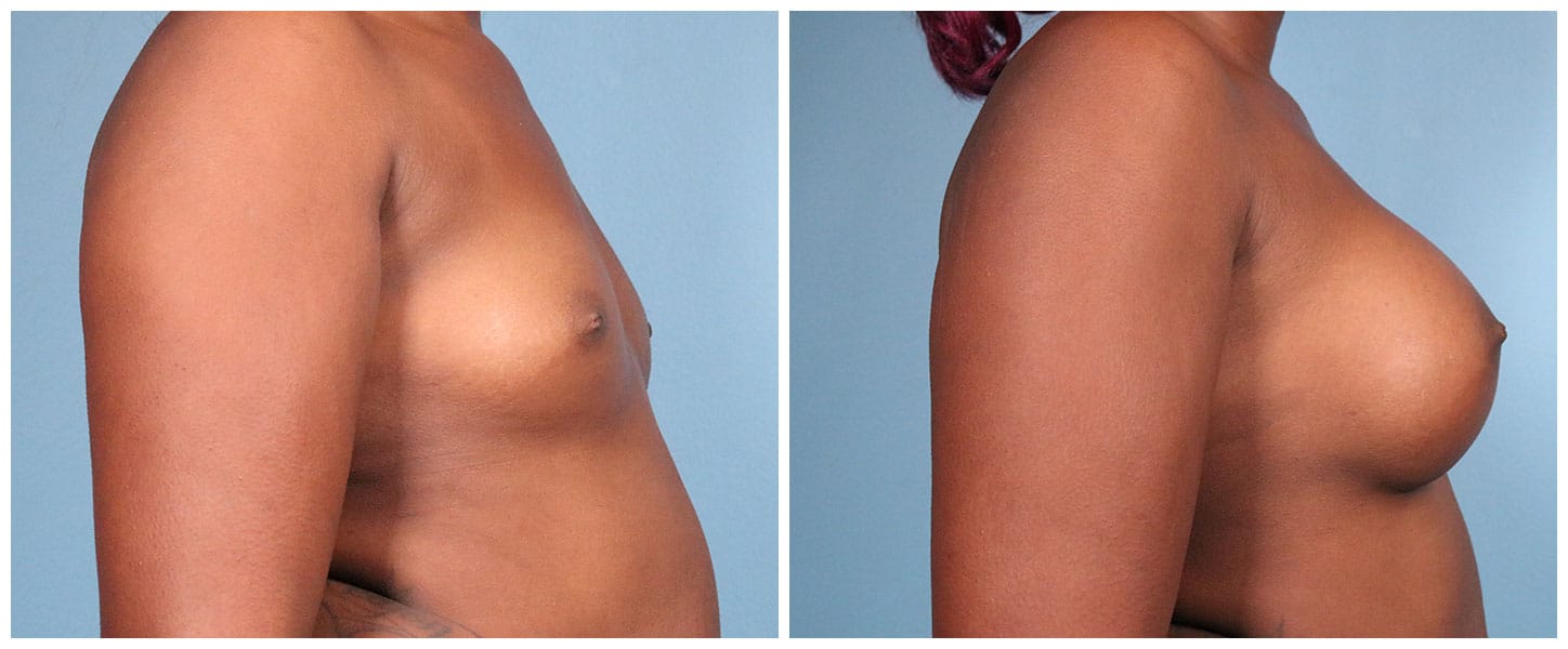 Breast Augmentation Case #6 Right