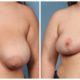 Breast Reduction Case #3 Front