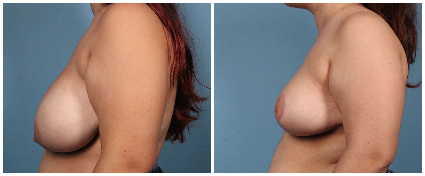 Breast Reduction Case #3 Left