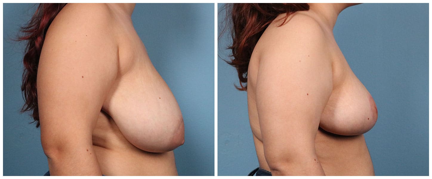 Breast Reduction Case #3 Right
