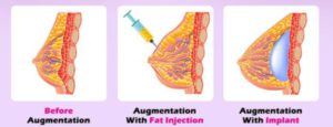 Fat Graft Breast Augmentation