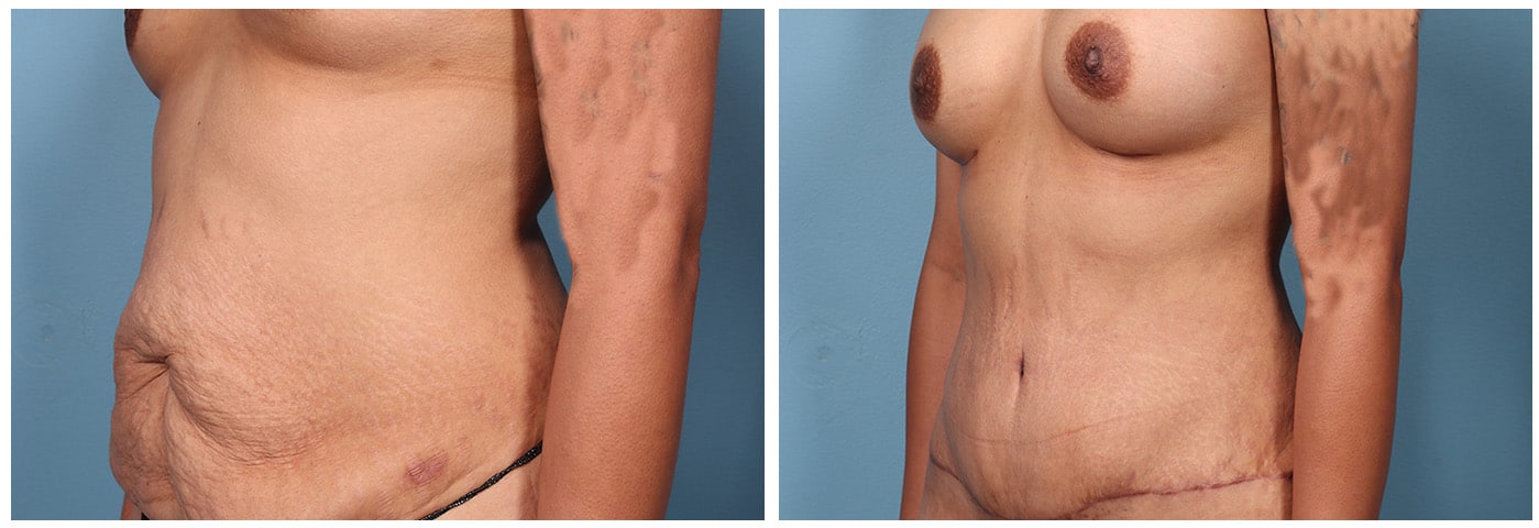 Mommy Makeover Case #1 Right oblique