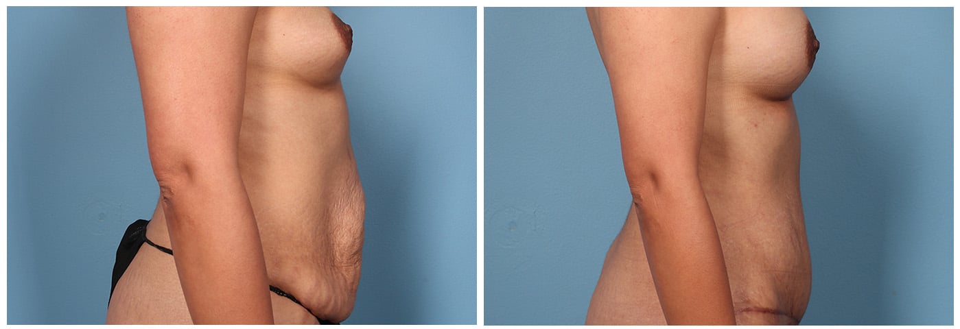Mommy Makeover Case #1 left oblique