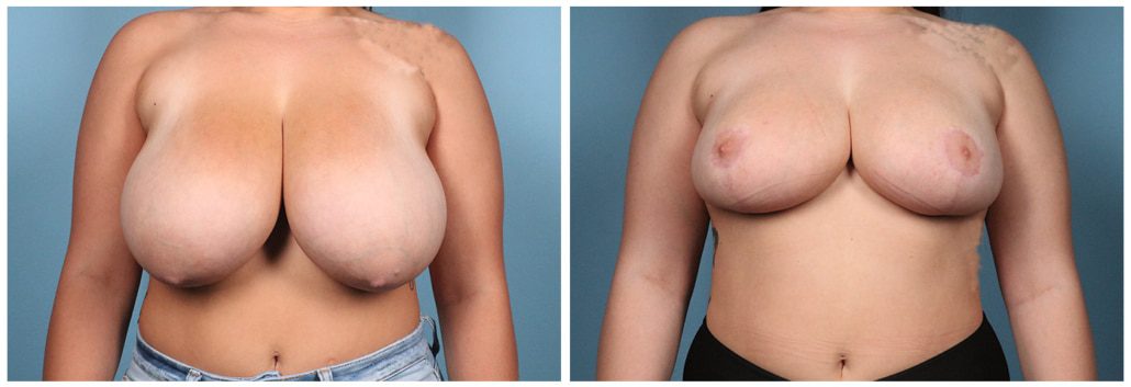 Breast Reduction Case #5 Front