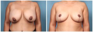 Breast Reduction Case #4 Front