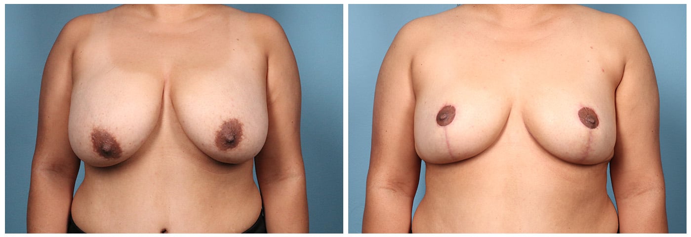 Breast Reduction Case #4 Front