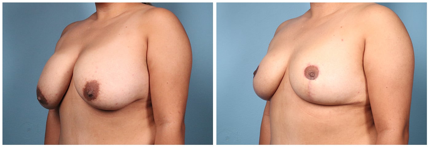Breast Reduction Case #4 Left Oblique