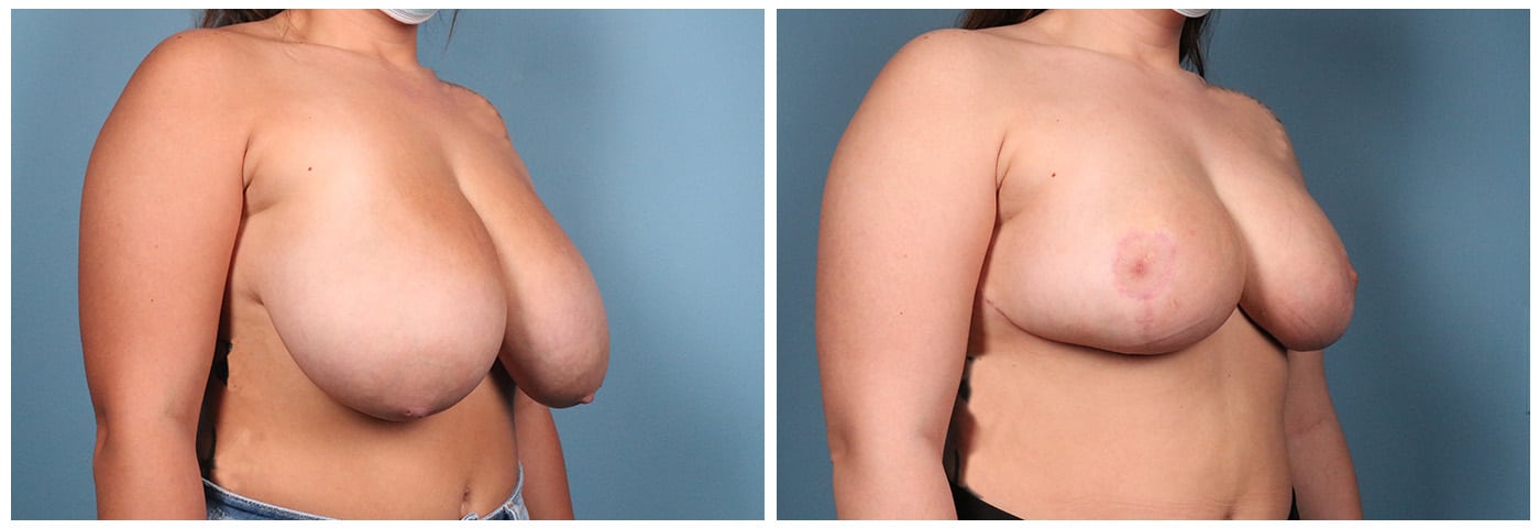 Breast Reduction Case #5 Right oblique
