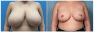 Breast Reduction Surgery Recovery