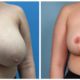 Breast Reduction Case #6 front