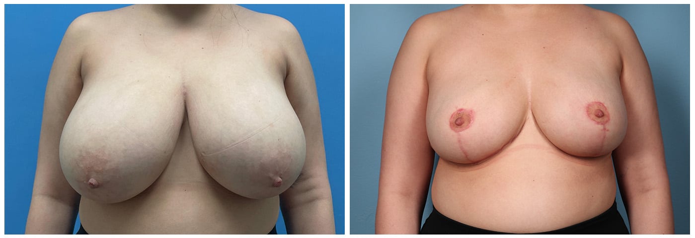 Breast Reduction Case #6 front