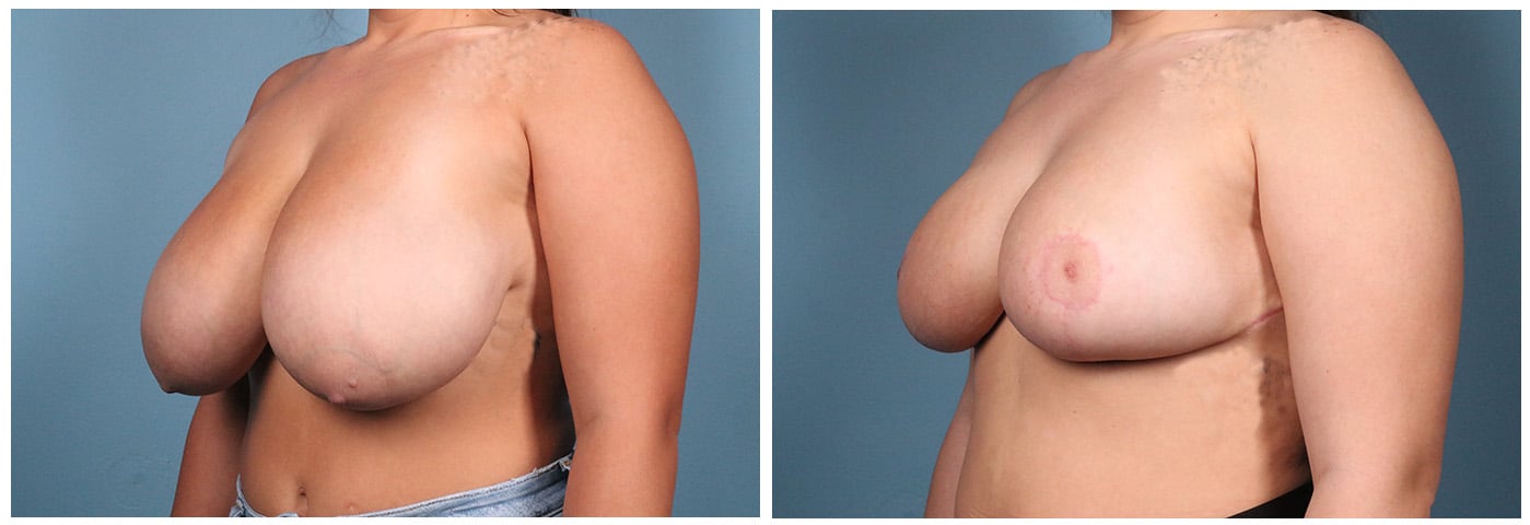 Breast Reduction Case #5 left oblique