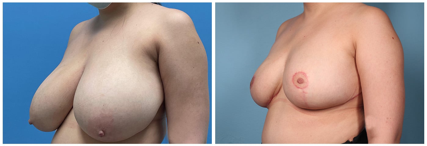 Breast Reduction Case #6 left oblique