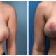 Breast Reduction Case #8 front
