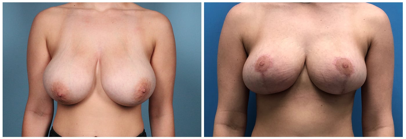 Breast Reduction Case #8 front