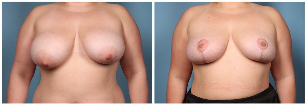Breast Reduction Case #7 front