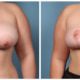 Breast Reduction Case #7 front