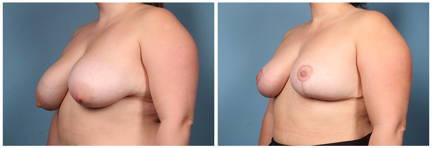 Breast Reduction Case #7 left oblique