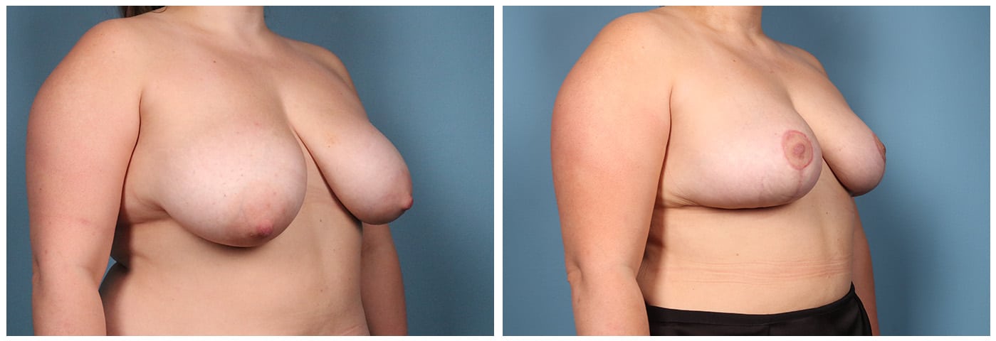 Breast Reduction Case #7 right oblique