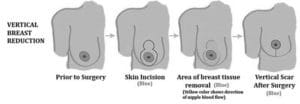 Vertical Incision Method Breast Reduction Houston
