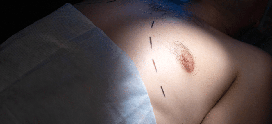 7 Ways To Predict Your Gynecomastia Surgery Cost