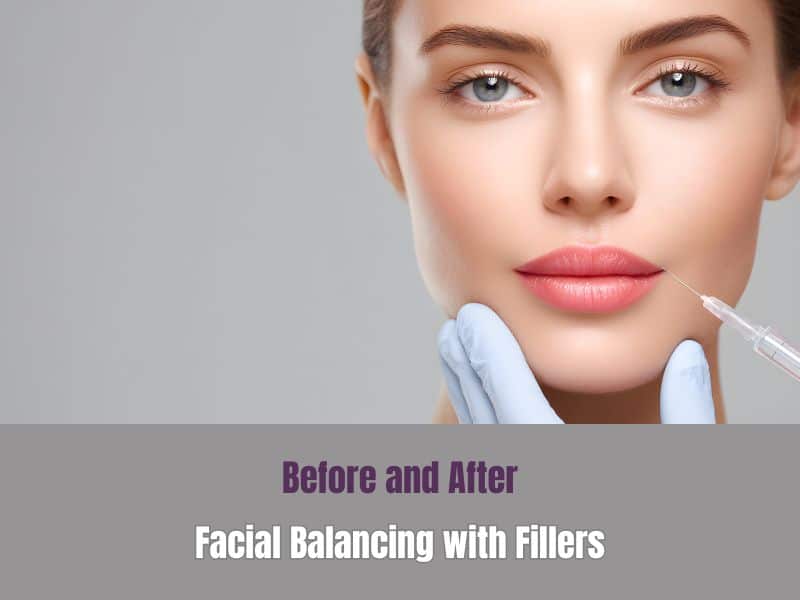 Before and After Facial Balancing with Fillers