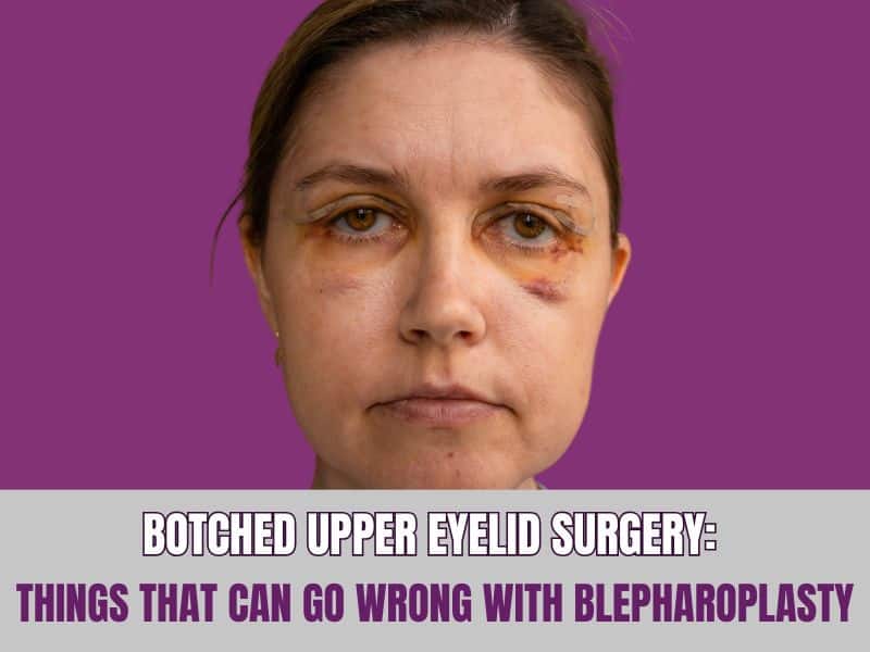 Botched Upper Eyelid Surgery Things That Can Go Wrong With Blepharoplasty