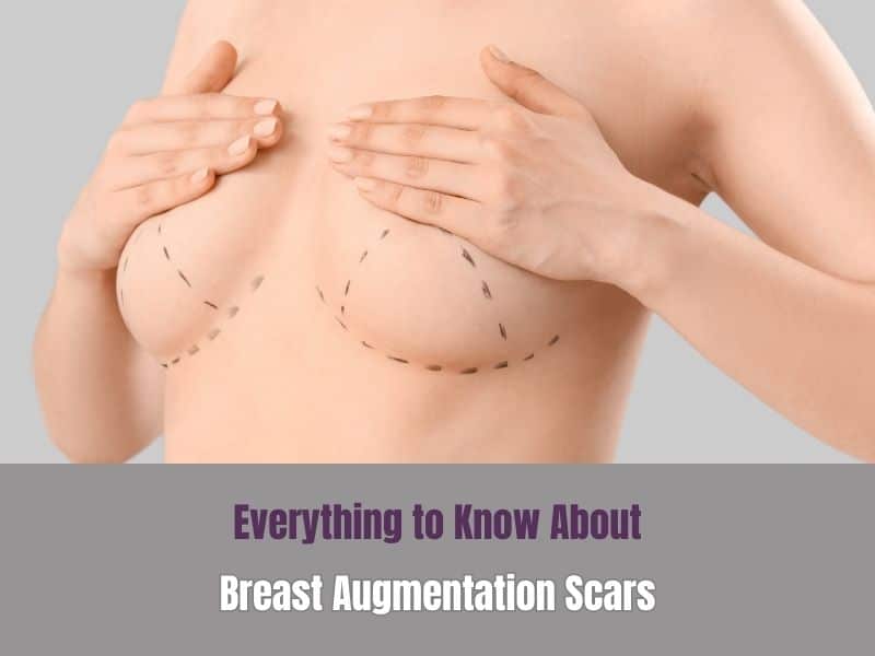 Breast Augmentation Scars