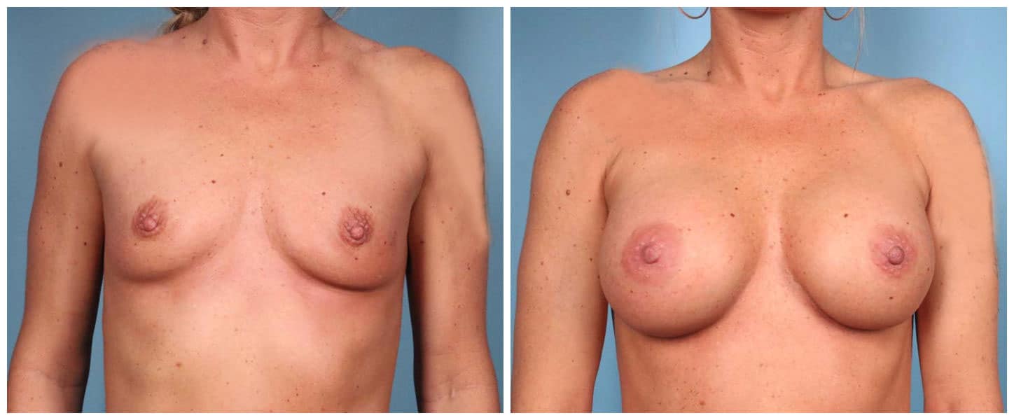 Breast Augmentation in Houston